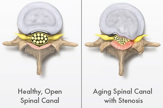 Side-by-side illustrations of a healthy spinal canal versus an aging spinal canal with stenosis